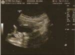 Alice Avery Price ultra sound