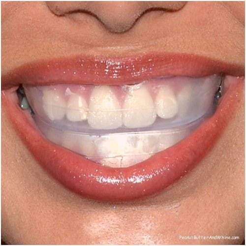 teeth whitening