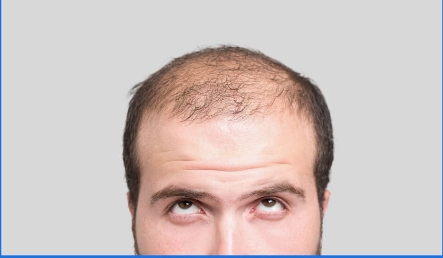 Balding man