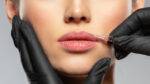 lip filler Getting Lip Fillers For The First Time