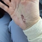 Business on PBnWhine Surgery scars