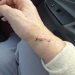 Business on PBnWhine Surgery scars