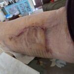 Business on PBnWhine Surgery scars